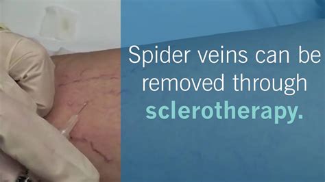 Safely Remove Spider Veins With Sclerotherapy Youtube