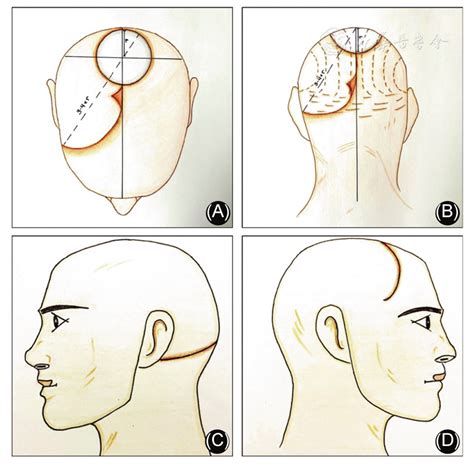 Use Of The O Z Flap As An Alternative To Free Tissue Transfer For