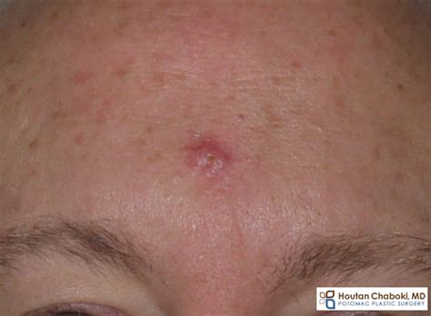 Get Images Of Skin Cancer On Forehead Images