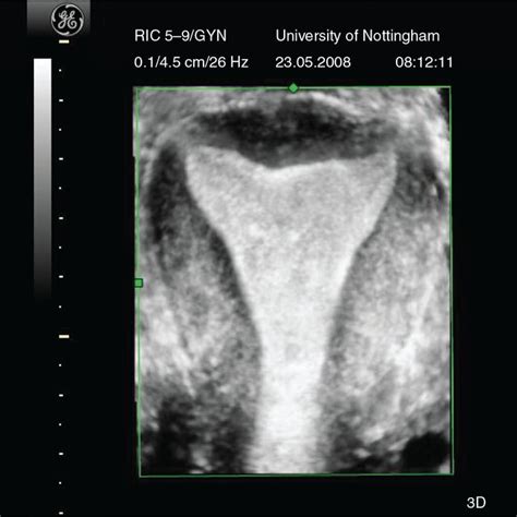 Rendered View Of A Normal Uterus Download Scientific Diagram