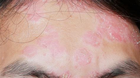 Psoriasis Help 4 Friends What Can I Do About Facial Psoriasis