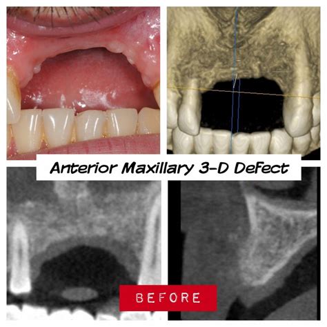 5 Anterior Maxilla Defect Before Failed Bone Graft Complications