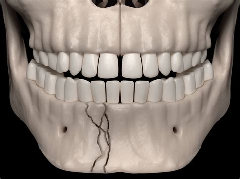 Ce Activity Mandible Fracture Dentist