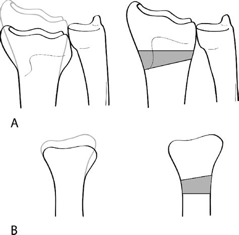 Schematic Representation Of The Corrective Osteotomy Procedure Of The