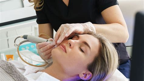 Are Hydrafacials Good For Acne Anna Medical Aesthetics