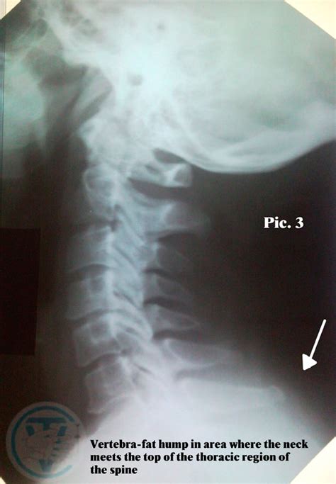 Surgery is reserved for severe cases of kyphosis. Manual-aesthetic-medicine