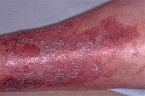 Differential Diagnoses Lower Leg Eczema Gponline
