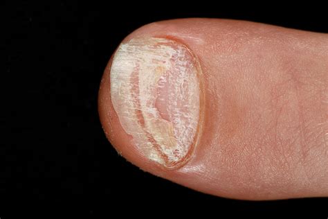 Fingernail Psoriasis Photograph By Science Photo Library