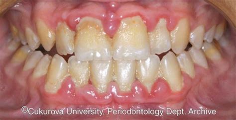 85 Atlas Of Periodontal Diseases Pocket Dentistry
