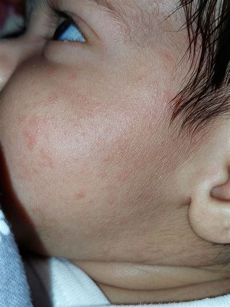 Small Bumps On Babys Skin Babycenter