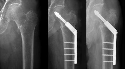 Risk Factors Of Fixation Failure In Basicervical Femoral Neck Fracture