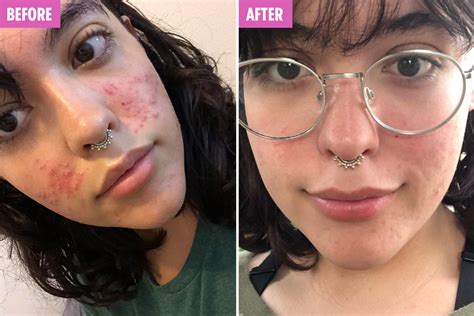 Acne Sufferer Claims £18 Snail Serum Cleared Her Cystic Spots And