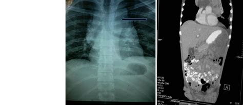 A Chest X Ray Superior Mediastinal Mass Likely Lymph Node Enlargement