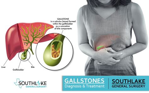 Gallstone Diagnosis And Treatment At Southlake General Surgery Texas
