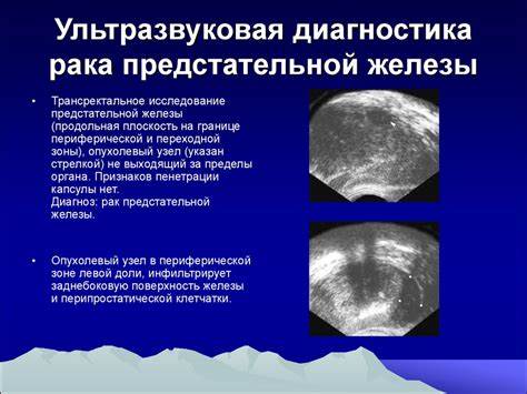 Диета после рака предстательной железы