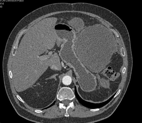 Omental Infarct Left Upper Quadrant Following Distal Pancreatectomy And