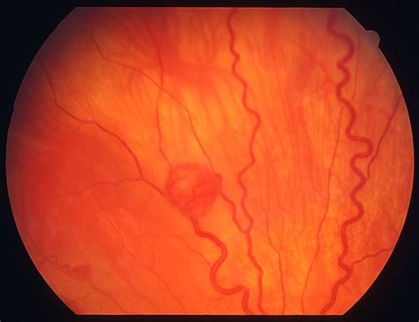 Retinal Capillary Hemangiomas 3 Retina Image Bank