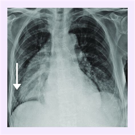 Bilateral Interstitial Pneumonia In A Patient With Esophageal Cancer