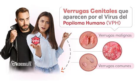 Diagn Stico Y Tratamientos Para El Papiloma Humano Vph Quito