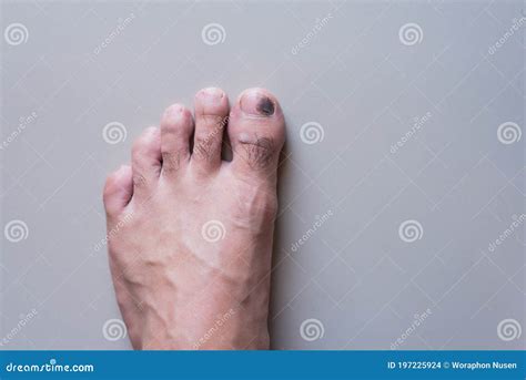 Close Up Of Hematoma On The Feet Stock Photo Image Of Barefoot Foot