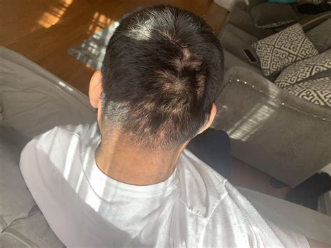 100以上 bumps back of head after haircut 837525 Bump on back of head