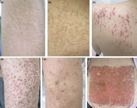 Possible Involvement Of Zinc Deficiency In Epidermal Growth Factor