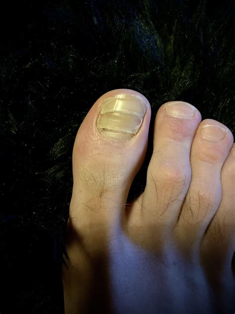 752 Best Toenail Images On Pholder Make Me Suffer Verified Feet And Tihi