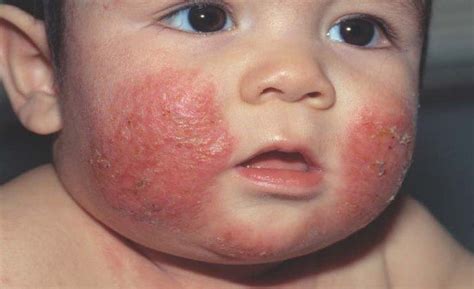 Treatment Of Atopic Dermatitis In Children Vinmec