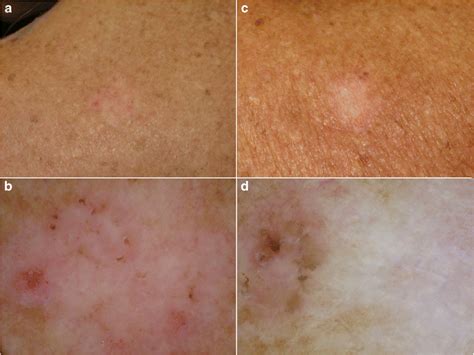 Clinical A And Dermoscopic B Images Of A Basal Cell Carcinoma