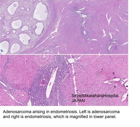 Pathology Outlines Adenomyosis
