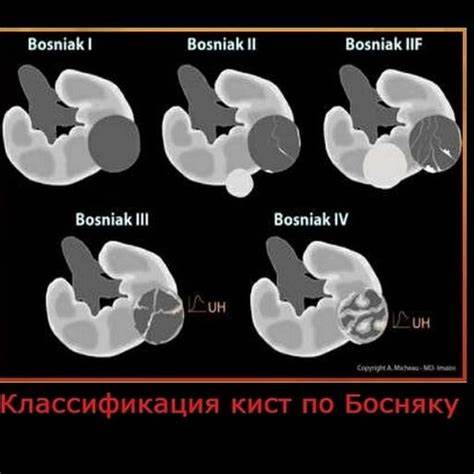 Классификация кист почек по Босниак: признаки Картинка - Классификация кист почек по Босниак: признаки
