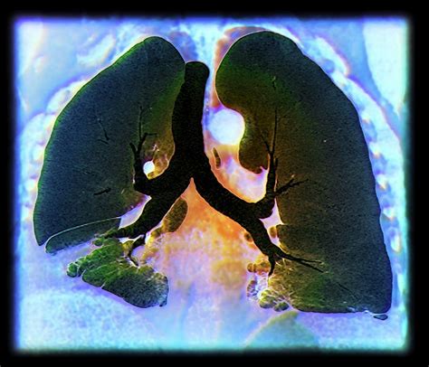 Kaposis Sarcoma Of The Lung Photograph By Zephyrscience Photo Library