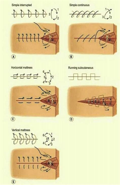 Types Of Stitch Sutures Surgical Nursing Medical School Studying