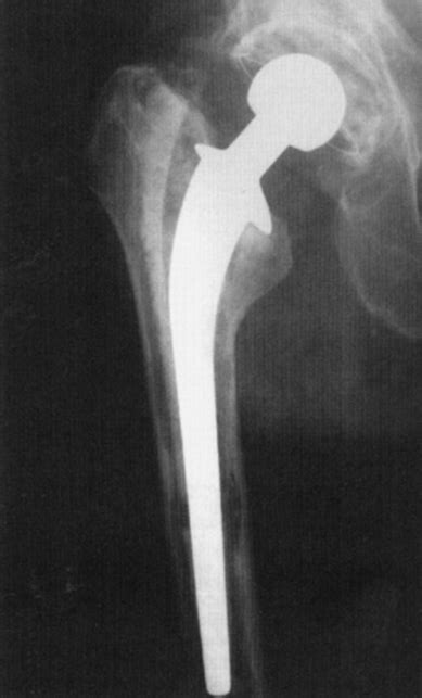 Imaging Of The Hip Teachme Orthopedics