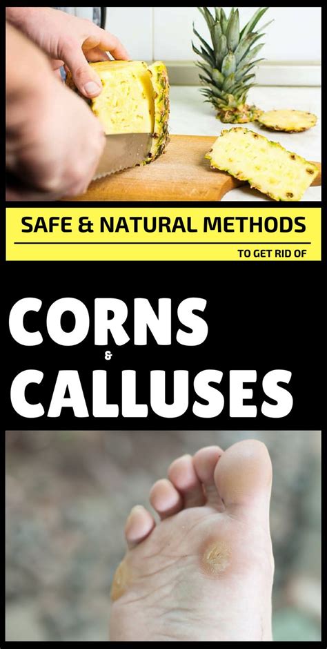 Safe And Natural Methods To Get Rid Of Corns And Calluses At Home With
