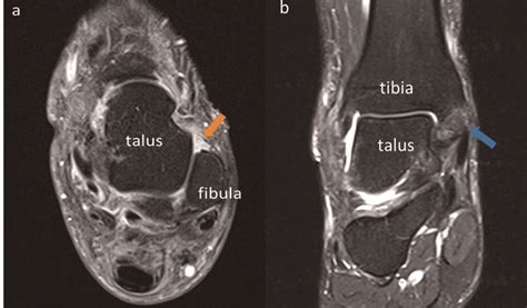 Mri Of Injured Ankle Ligaments A Axial View Of The Left Ankle The