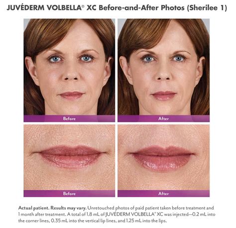 Volbella Facial Filler Lipstick For Fair Skin Juvederm How To Line Lips