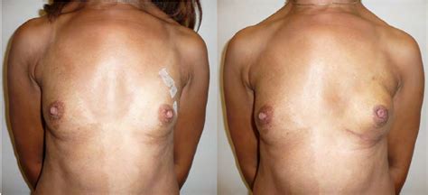 Left Breast Reconstruction With Omentum Flap After Left Mastectomy