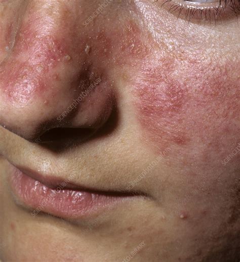 Acne Rosacea Stock Image C0384496 Science Photo Library