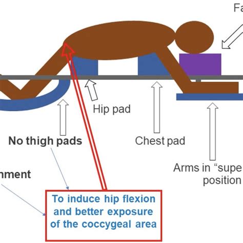 Scheme Depicting The Prone Position Of The Patient To Perform