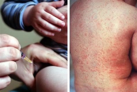 Huge Rise In Measles And Scarlet Fever Cases In Essex In 2018 Public Health England Data