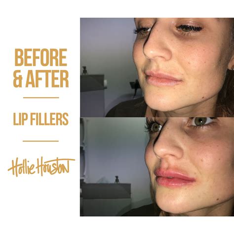 Lip Fillers 💋 Before And After Of Beautiful Lip Fillers 👄 The Colour