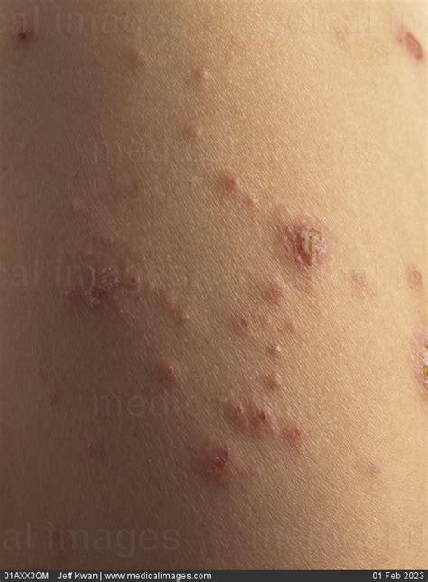 Stock Image Spongiotic Dermatitis Eczema Female Patient 195902