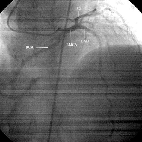 Coronary Angiography Right Anterior Oblique View With A Caudal