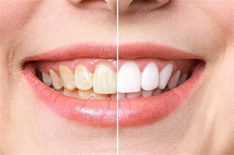 10 Reasons To Whiten Your Smile In Mesa Az Top Rated Cosmetic