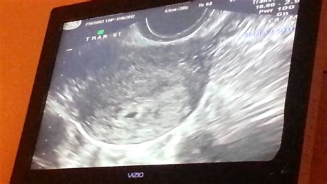 First Ultrasound 4 Weeks 1 Day Youtube