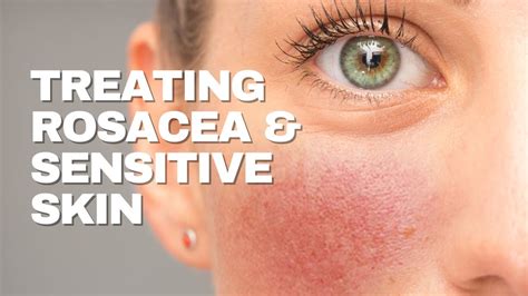 Treating Sensitive Skin And Rosacea Youtube