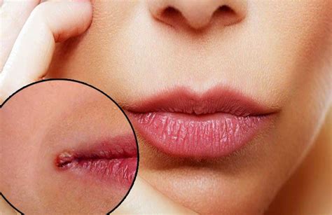 How To Cover Up A Cold Sore In The Corner Of Your Mouth Mohammed Meade