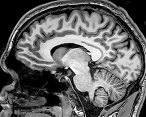 Normal Sagittal T1 Mri Brain 8 Stock Image C0393738 Science