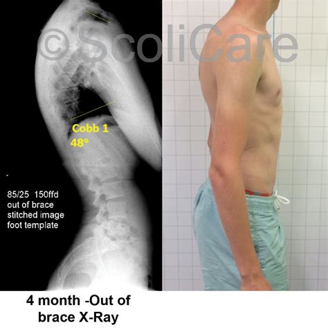 Case Study Kyphosis Bracing Scoliosis Clinic Uk Treating Scoliosis
